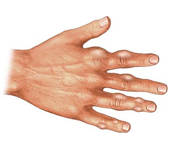 Εναπόθεση κρυστάλλων ουρικού οξέος στους μαλακούς ιστούς των δακτύλων στην ουρική αρθρίτιδα