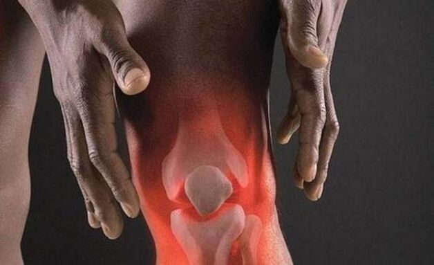 Η οστεοαρθρίτιδα συνοδεύεται από μια φλεγμονώδη διαδικασία στην άρθρωση του γόνατος