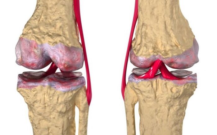 Οστεοαρθρίτιδα της άρθρωσης του γόνατος